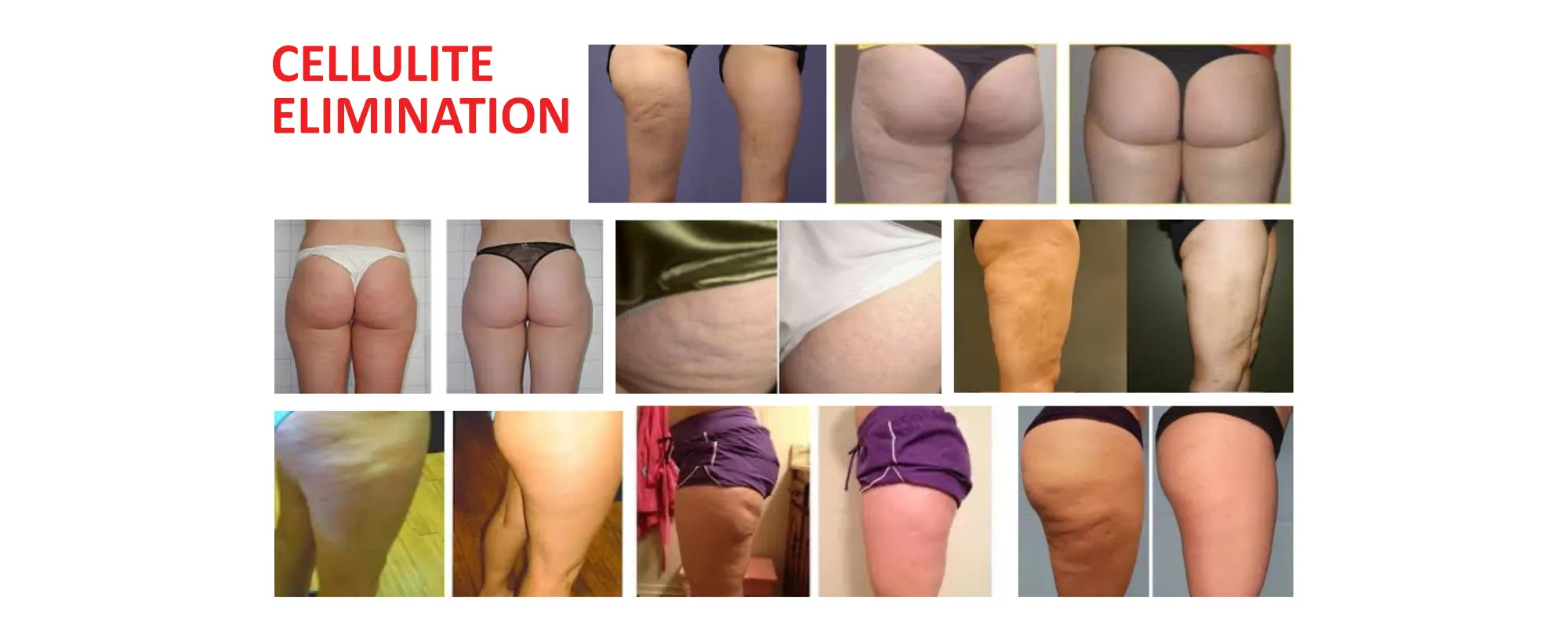 Weight Loss Lockport IL invisa-RED Cellulite Elimination