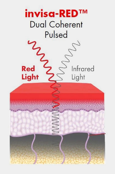 Weight Loss Lockport IL invisa-RED Dual Coherent Pulsed