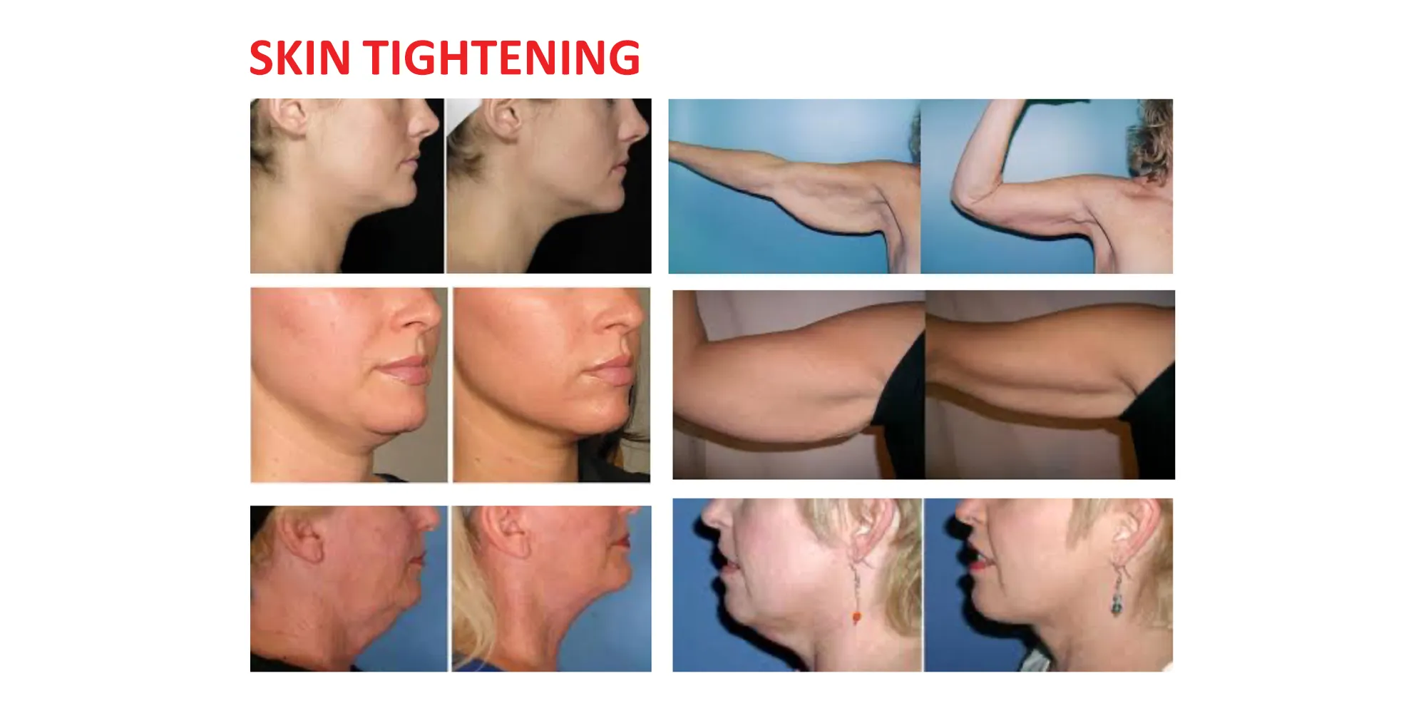 Weight Loss Lockport IL invisa-RED Skin Tightening